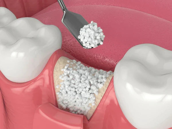 How Bone Graft Particle Size Affects Healing Time and Volume?
