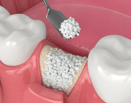 How Bone Graft Particle Size Affects Healing Time and Volume?