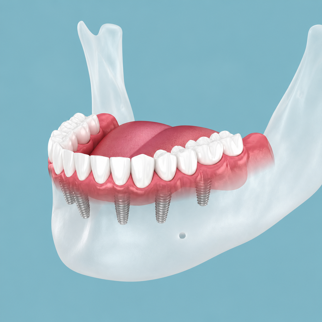 How to Achieve a Precise All-on-4 Shelf with Ridge Reduction Burs?