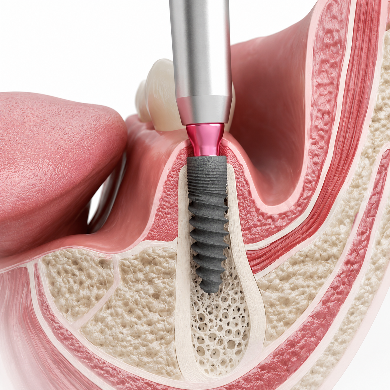 When Is a Dental Bone Graft Needed?