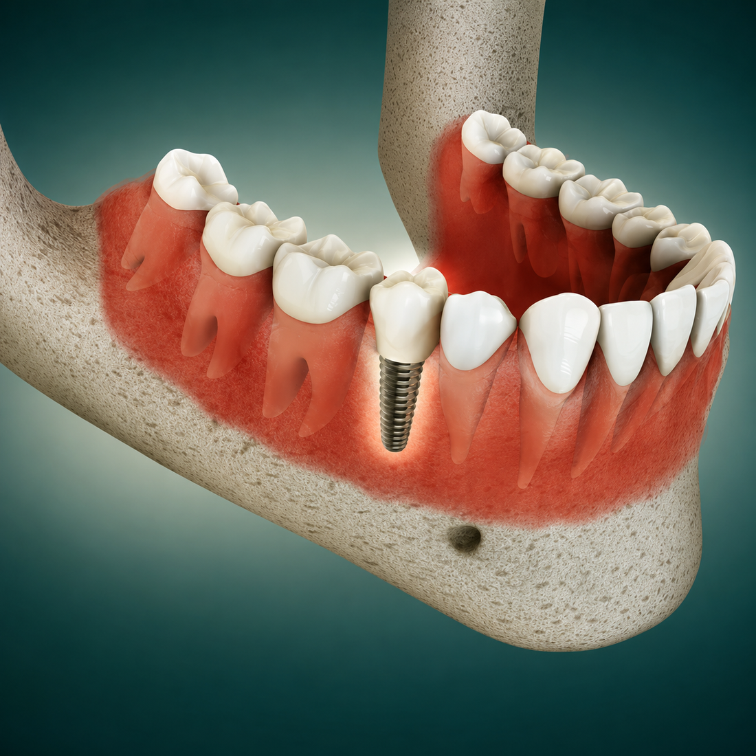 How Dental Bone Graft Surgery Is Done: Step-by-Step Guide