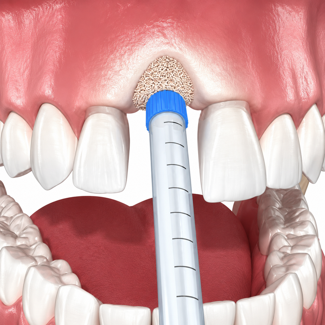 How Much Bone is Needed for a Dental Implant? Socket Preservation & Guided Bone Regeneration Explained