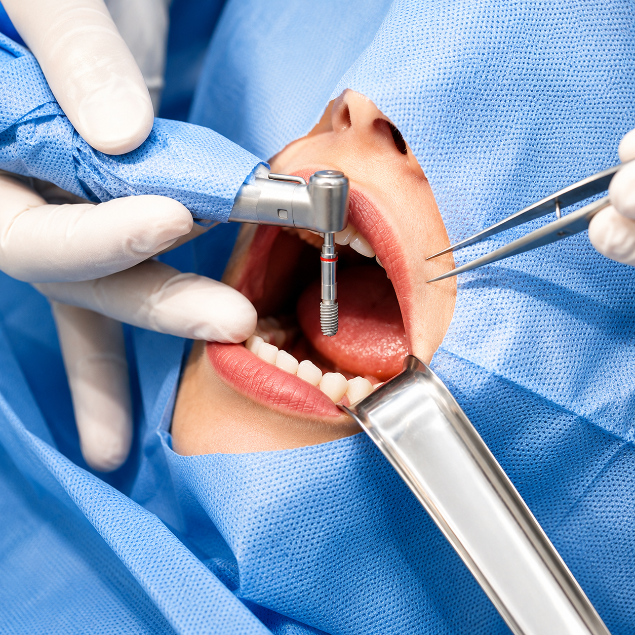 How to Choose the Right Bone Graft Size for Dental Implant Procedures?