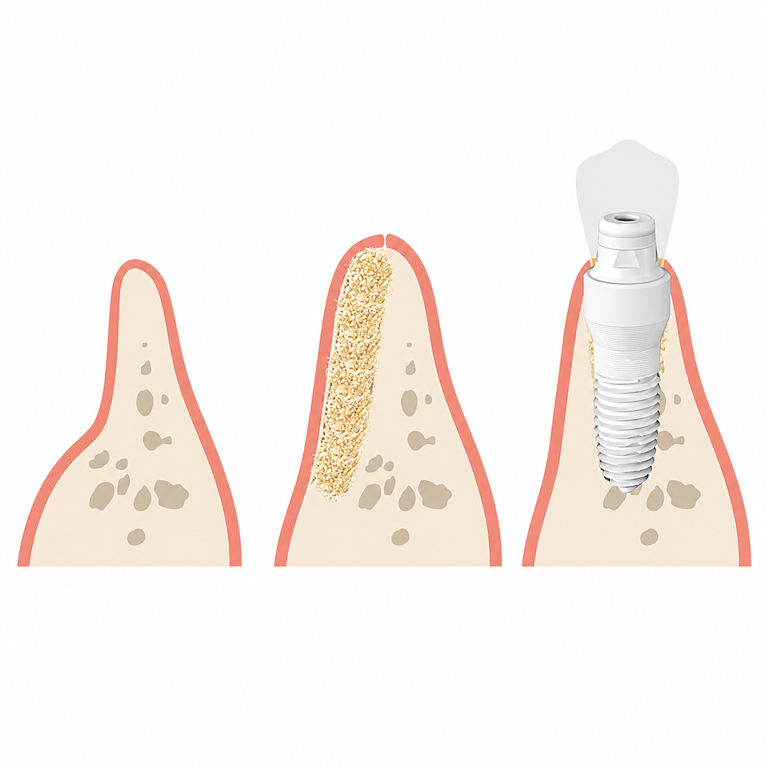 What Is Dental Bone Grafting?