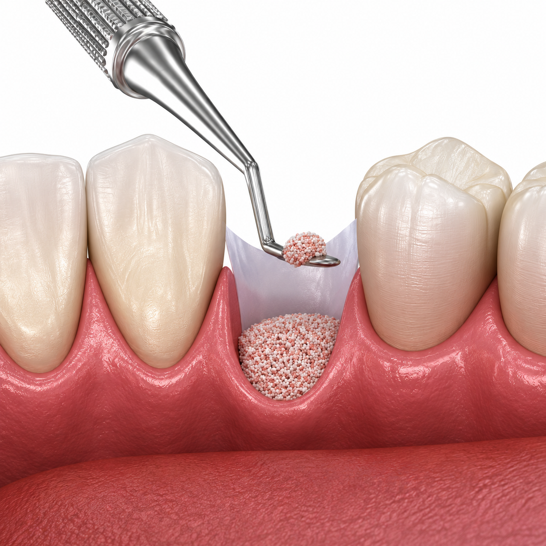 5 Hidden Risks of Using Substandard Bone Grafts for Oral Surgery