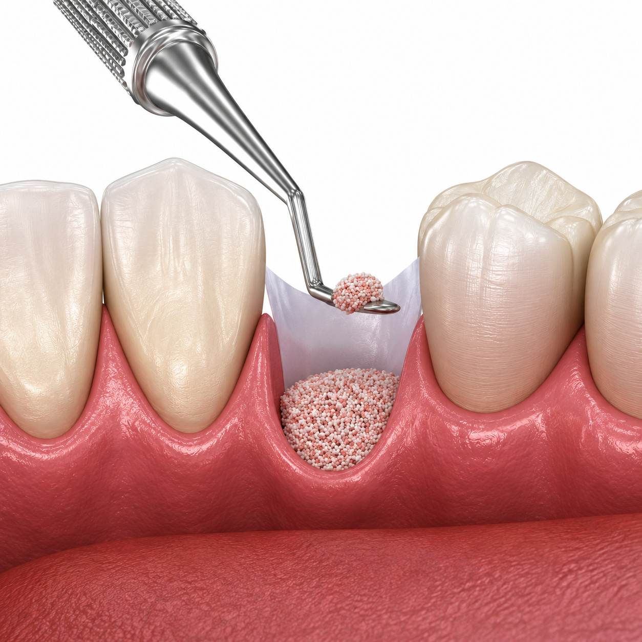 5 Hidden Risks of Using Substandard Bone Grafts for Oral Surgery
