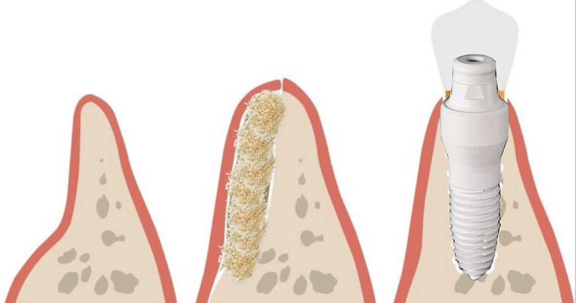 What Is Dental Bone Grafting?