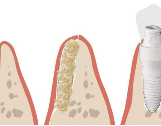 What Is Dental Bone Grafting?
