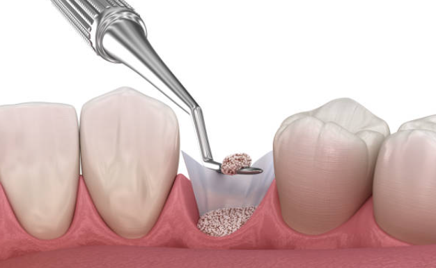 5 Hidden Risks of Using Substandard Bone Grafts for Oral Surgery