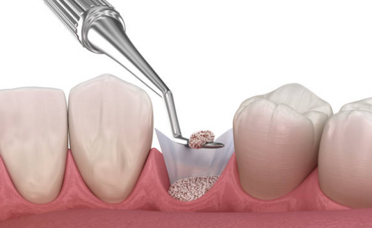 5 Hidden Risks of Using Substandard Bone Grafts for Oral Surgery