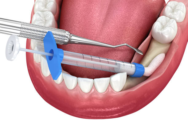 Types of Dental Bone Graft Materials