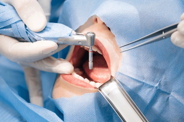 Mineralized vs. Demineralized Bone Grafts: Which Is Better for Implant Success?