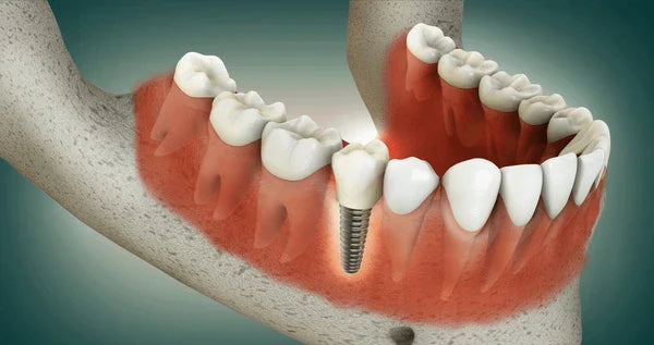 How Dental Bone Graft Surgery Is Done: Step-by-Step Guide