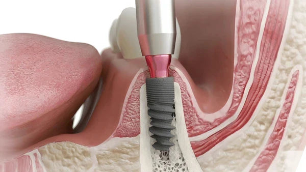 When Is a Dental Bone Graft Needed?