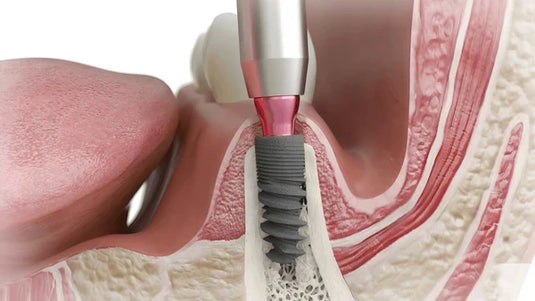 When Is a Dental Bone Graft Needed?