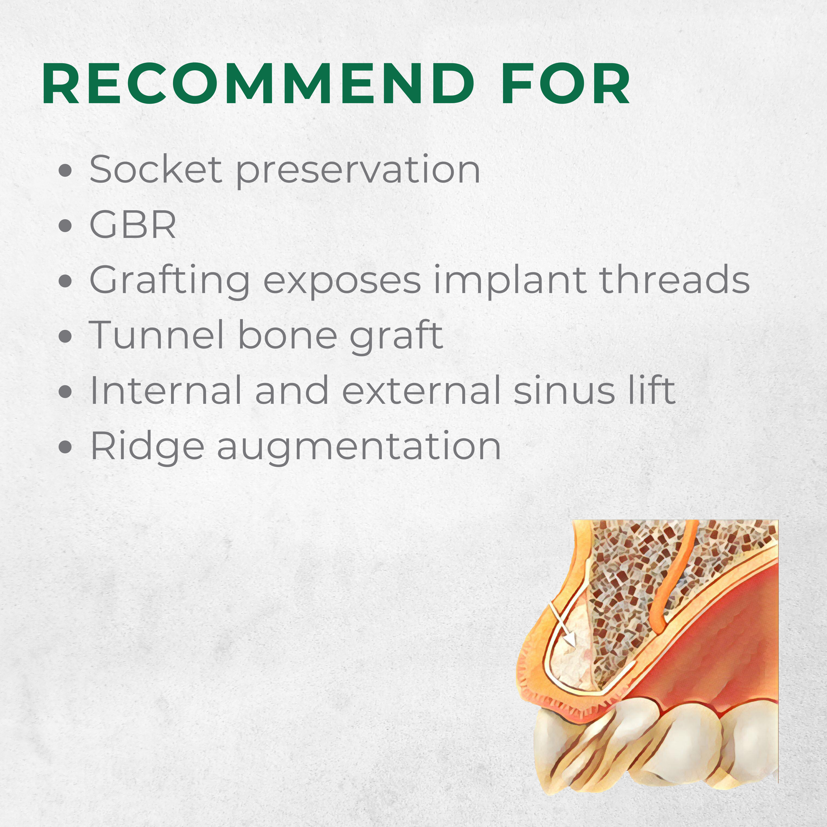 Vitality™ 1.0 CC Mineralized 70/30 Cortical Cancellous Mix 500- 1000 Micron Allograft Bone