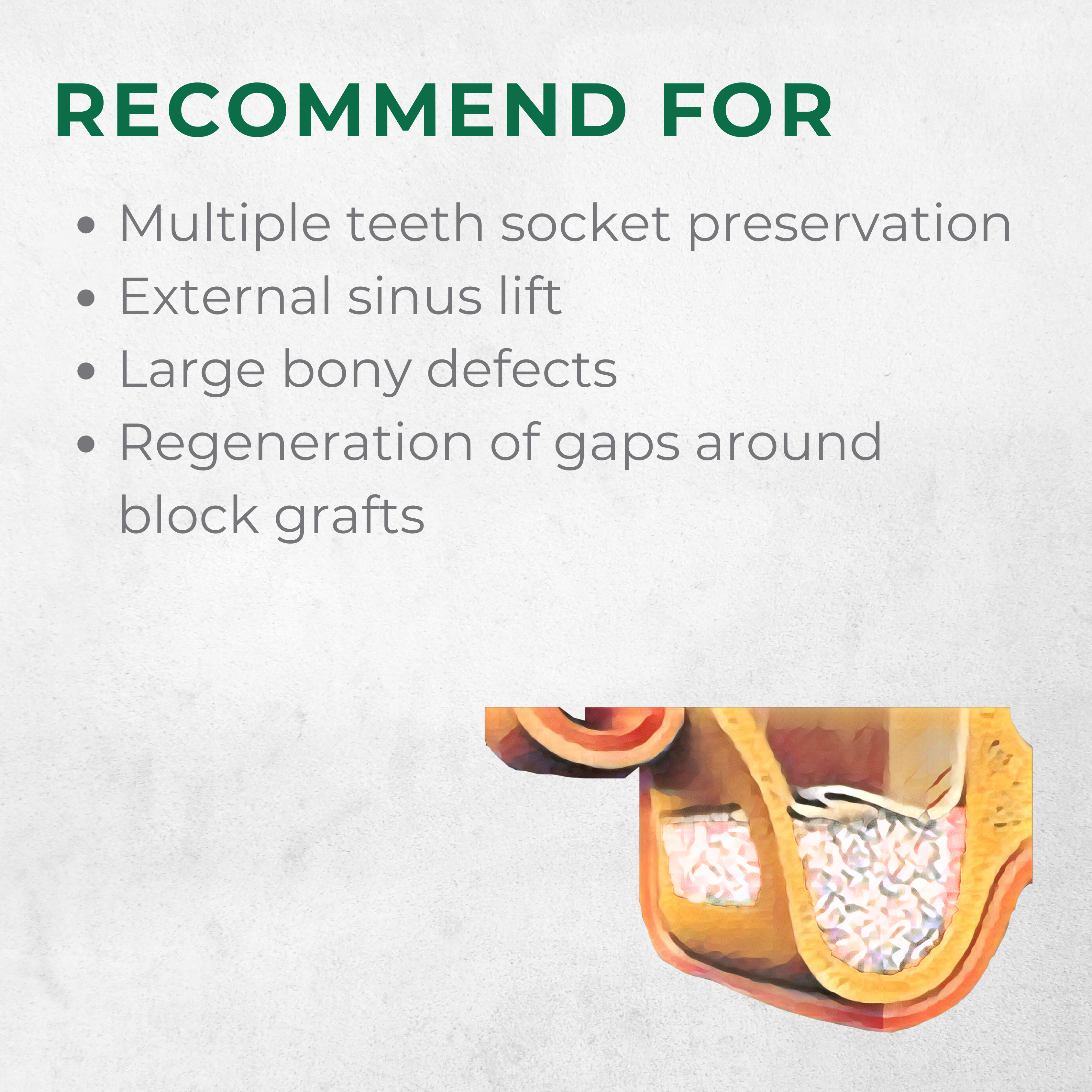 Vitality™ 2.0 CC Mineralized 70/30 Cortical Cancellous Mix 500- 1000 Micron Allograft Bone