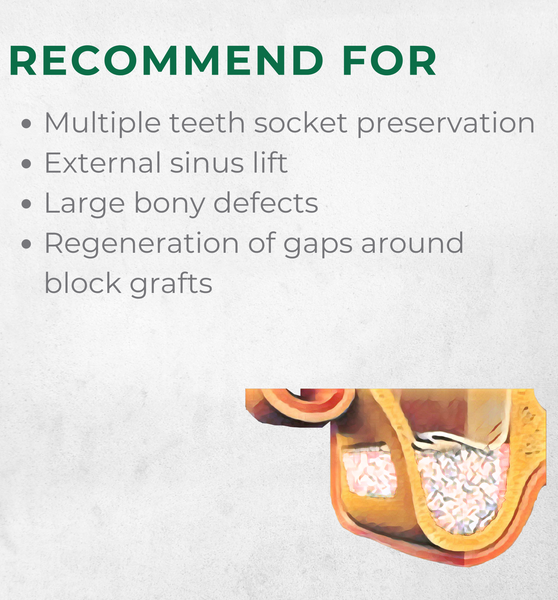 Vitality™ 2.0 CC Mineralized 70/30 Cortical/Cancellous Allograft Blend