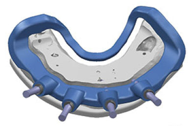 Ridge Reduction/ Contouring Bur (5 Per Pack)-Vitality™