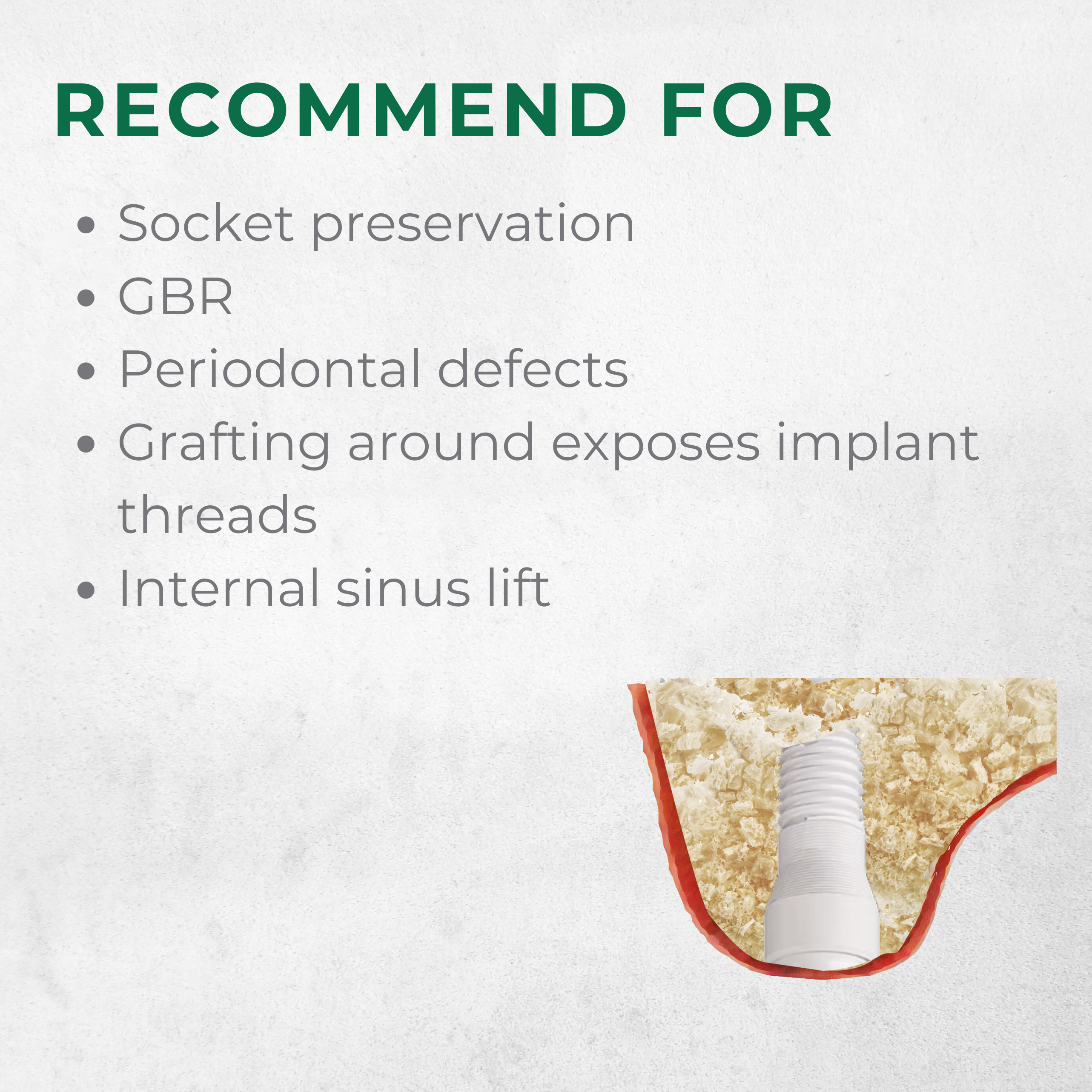 Vitality™ 0.5 CC Mineralized 70/30 Cortical Cancellous Mix 500- 1000 Micron Allograft Bone
