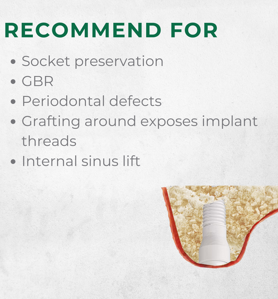 Vitality™ 0.5 CC Mineralized 70/30 Cortical Cancellous Mix 500- 1000 Micron Allograft Bone